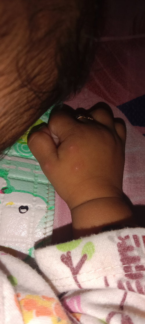 Kulit bayi bentol