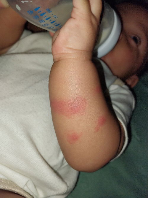 Bentol bentol pada lengan bayi