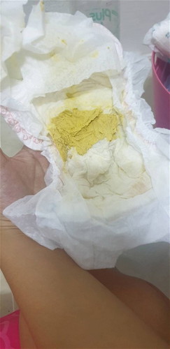 อึสีซีดลงจากปกติ