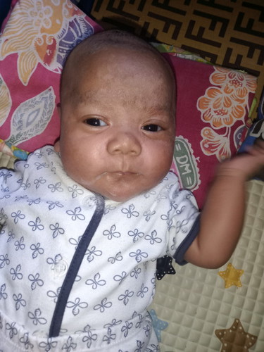 Ruam di atas alis