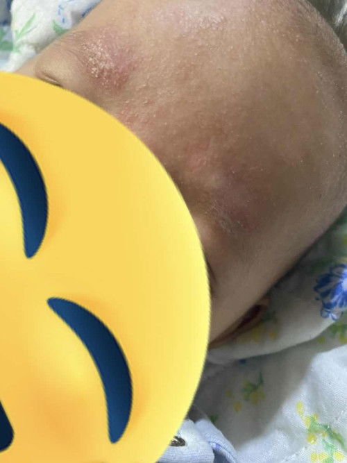 ผื่นแพ้เกิดจากอะไร