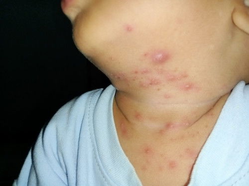 Ada yg tau ini kenapa & obatnya apa,karena sudah berobat cuma di kasih salep tapi belum ada perubaha