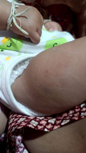 ฉีดวัคซีนแล้วขาบวม