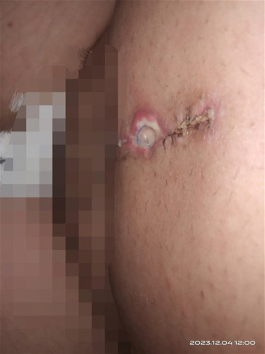 Incision wound