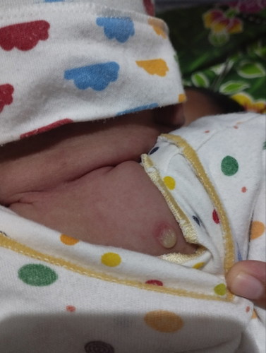 Bbrapa hari dari lahir muncul ky gtu ngelupas muncul lg, ada yg ngalamin? Itu apa ya bahaya ga?