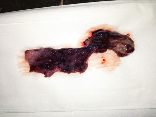 Hamil bo, keluar sendiri, tetep harus kuret?