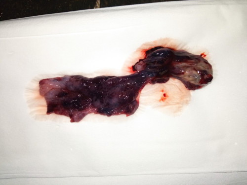 Hamil bo, keluar sendiri, tetep harus kuret?