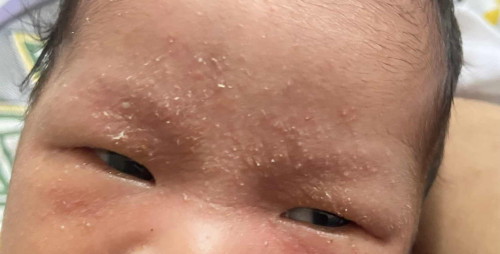 Rashes or allergies?