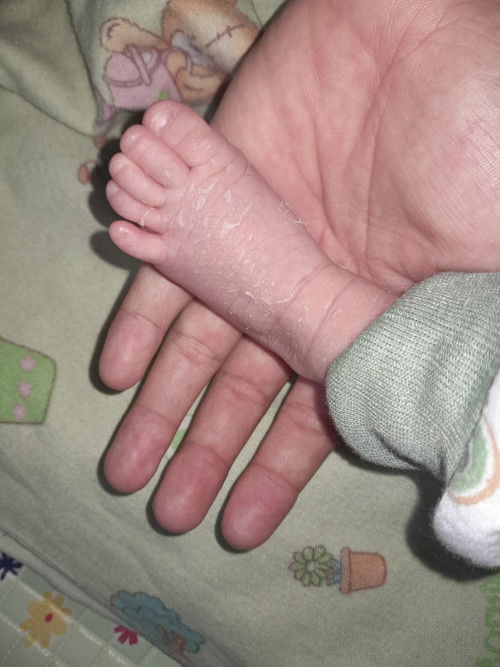 Kulit bayi newborn mengelupas