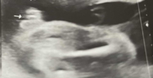 GENDER REVEAL
