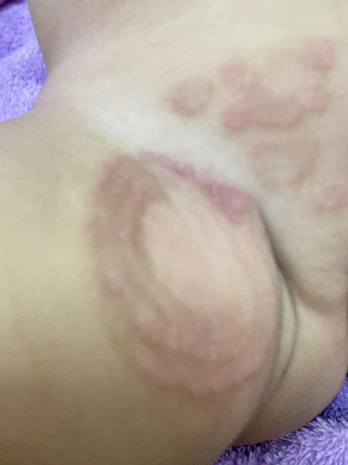 Ruam lampin masalah kulit ?