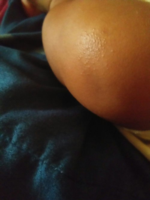 Bintik" pada lutut bayi 2 bulan