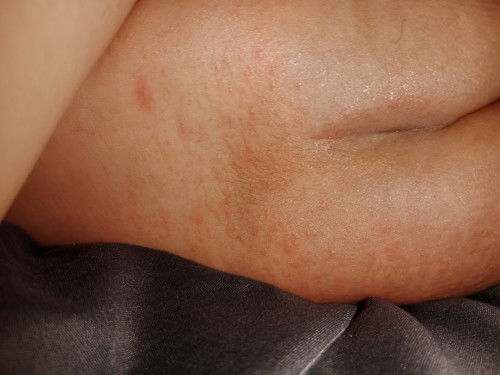 Bintik2 merah, seperti keringat buntat