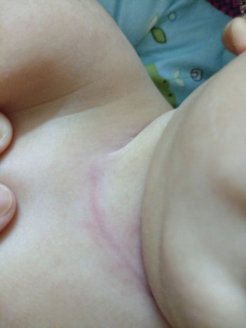 Ruam leher. Lepas cucuk 4bulan.