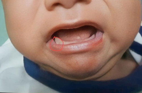 ตุ่มคล้ายหนอง