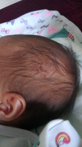 Cradle Cap po ba ito??