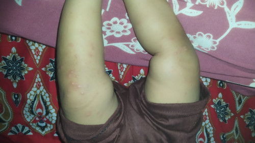 Muncul bintik2 merah