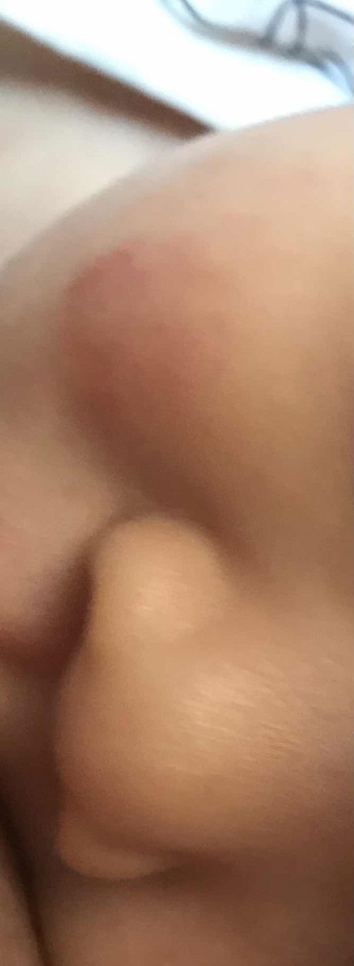 ทารกผื่นขึ้นหน้า