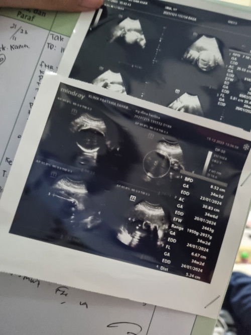 Usia kandungan 34 week