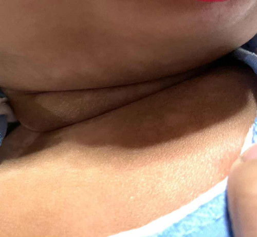 White spots sa leeg at ulo