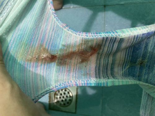 No pain pero may nalabas saken na ganito. Ano po kaya eto?