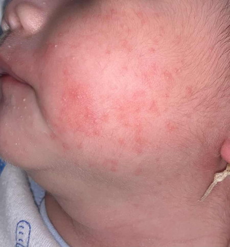 Bé nhà e nay bị nổi như vậy là bị gì vậy các mom lần đầu làm mẹ nên e hơi bỡ ngỡ..