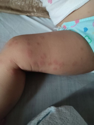 Insect bite or rashes