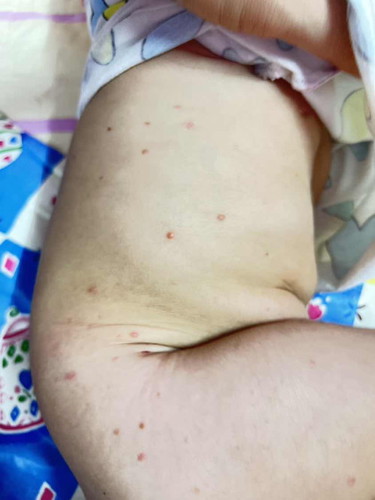 สอบถามแม่ๆ ลูกบ้านไหนมีตุ่มแดงๆขึ้นแบบนี้บ้างคะ