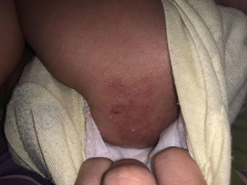 Ruam( bintil air di pantat bayi)