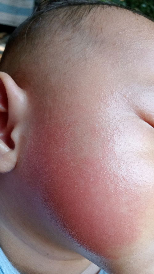 medadak muncul merah di pipi