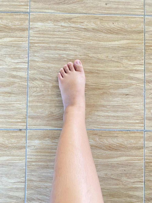 32w+3 เท้าบวม