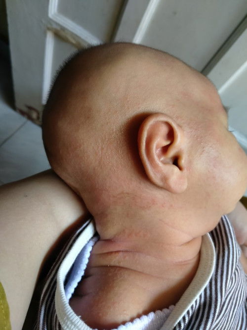 Kepala bayi bruntusan