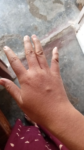 Muncul bintik2 seluruh tubuh dan gatal banget