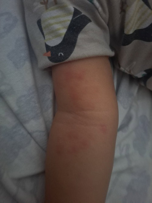 Help..kemerahan pada kulit bayi 10 bulan