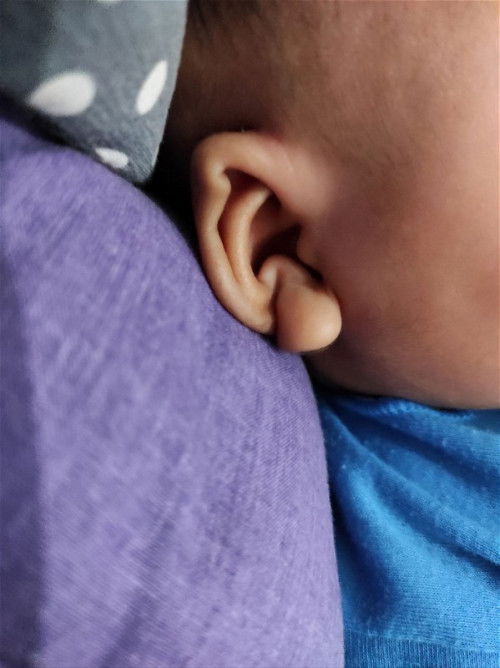 Telinga anak terlipat