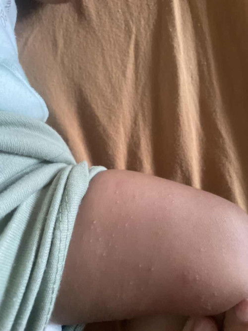 bintik bintik pada bayi