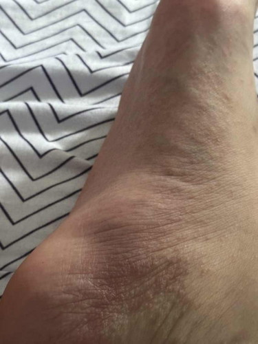 Keluar bintik2 kecik kat kaki gatal sangat masa pantang.