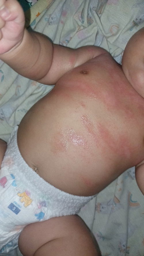 Kulit ruam kemerahan