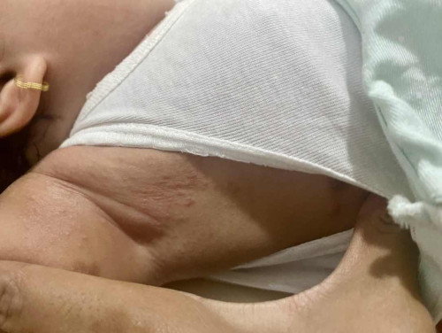 Bentol gatal pada bayi 7 bulan