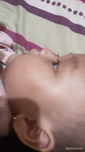 Bintik merah area hidung dan mata