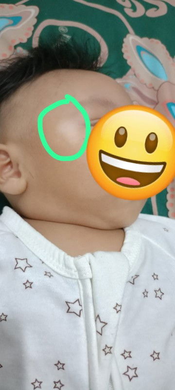 Bercak putih pada kulit wajah bayi bagian mata