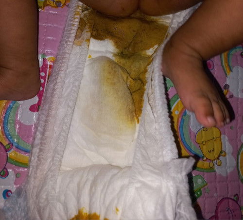 Maaf sy mau nanya, pup bayi diare apakah sperti ini? Bayi sy usia 3 bulan full asi