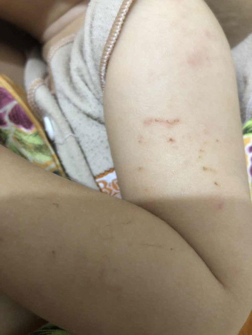 Bayi 9 bulan gatal2 di sekujur tubuh