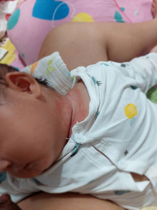 Tình trạng hăm ở bé