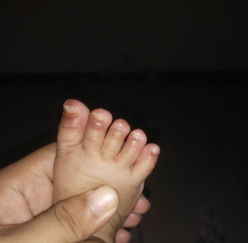 Kaki bayi 3 bulan bintik2 berair