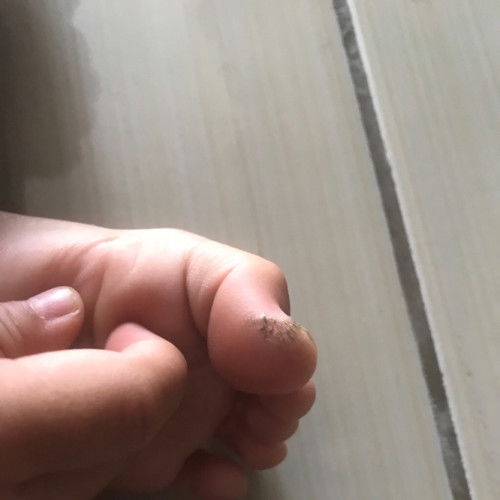 Kaki bayi pecah pecah