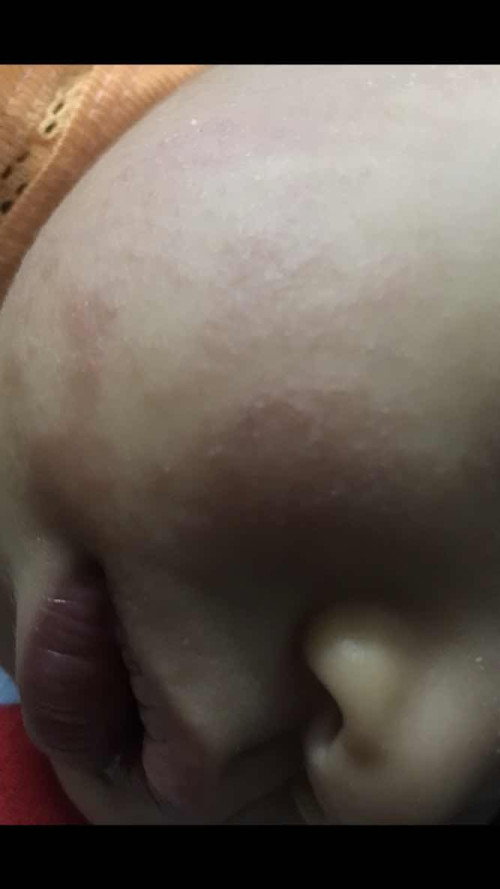 ทารกผิวแห้งมาก