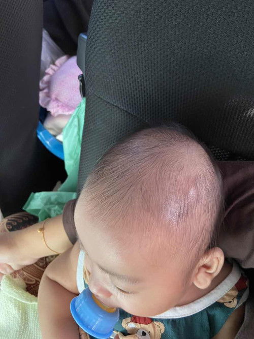 benjolan di kepala bayi