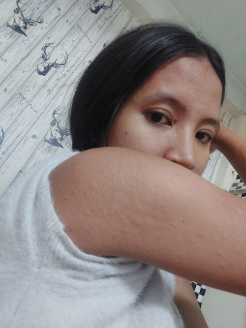 ท้องแล้วมีอาการคัน