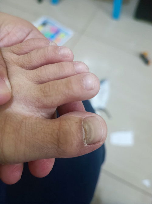 Magtatanong lang po ano po kaya possible problem sa kuko ng anak ko? Nagka HDMF po sya nung november